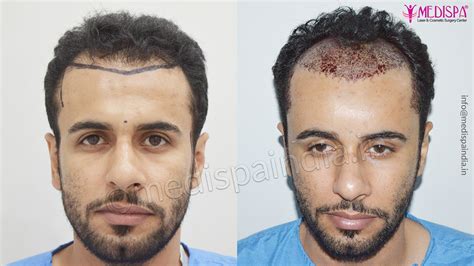 hair transplant dubai reviews